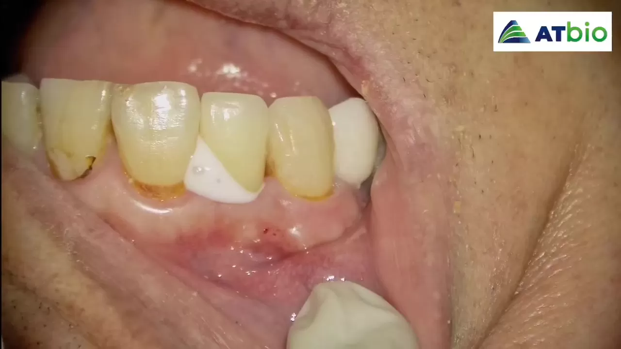 GK | GK Glass Ionomer Luting Cement Type I Clinical Applications