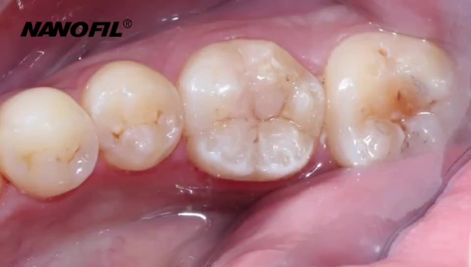 NANOFIL | Z250 Nanohybrid Composite Syringe | Posterior & Anterior Restoration