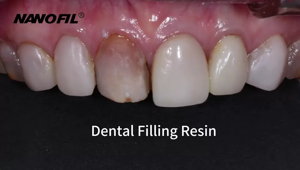 NANOFIL | Z250 Nanohybrid Composite Syringe |  Composite Resin Indirect Veneer Procedure for Deeply Discolored Anterior Teeth