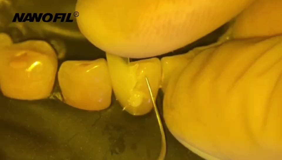 NANOFIL | Flowable Light-Cured Composite Resin | Diastema Closure & Repair