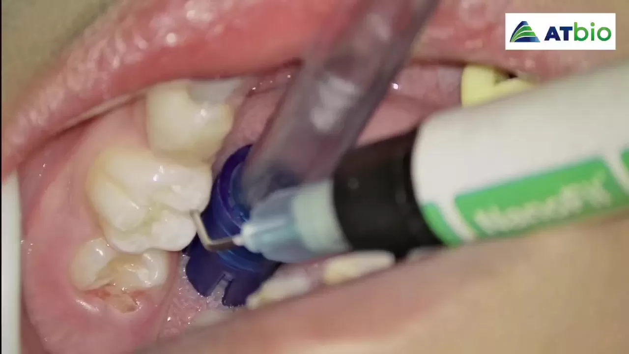 NANOFIL | Pit & Fissure Sealant Light-Cured | Clinical Applications